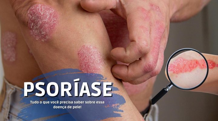 Psoríase: Tudo o que você precisa saber sobre essa doença de pele!